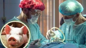 Pig Kidney Transplant