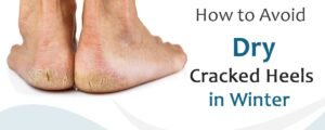 Cracked Heels Home Remedy