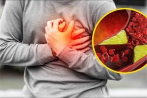 High Cholesterol Symptoms