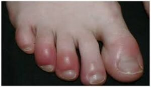 Winter Chillblains Treatment