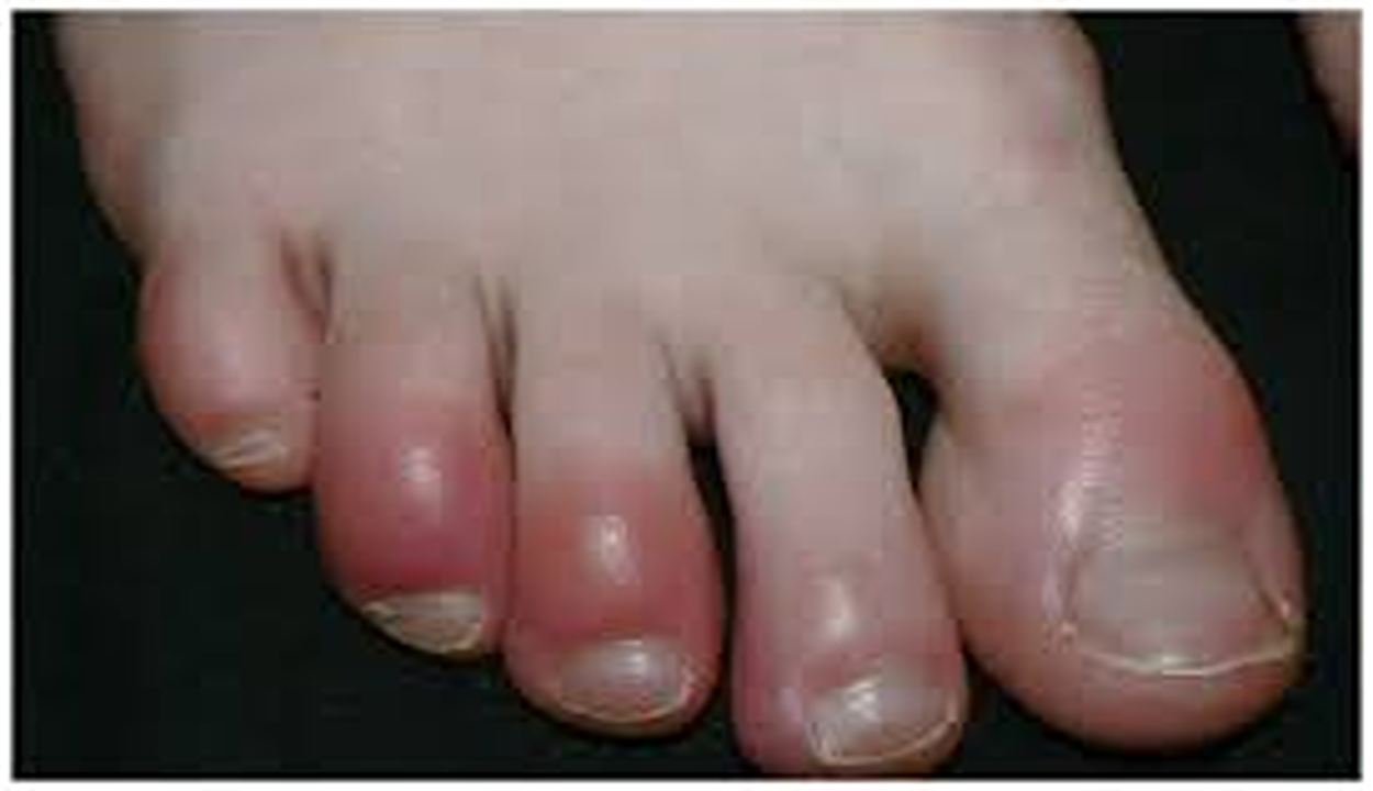 Winter Chillblains Treatment