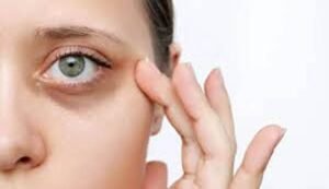 Eye Dark Circles Causes and Remedies