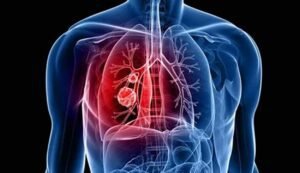 Lung Cancer Trends India 2030