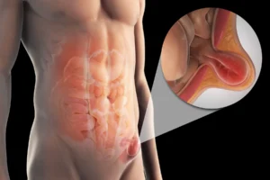Silent Hernia Symptoms