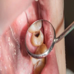 oral health home remedies cavity pain