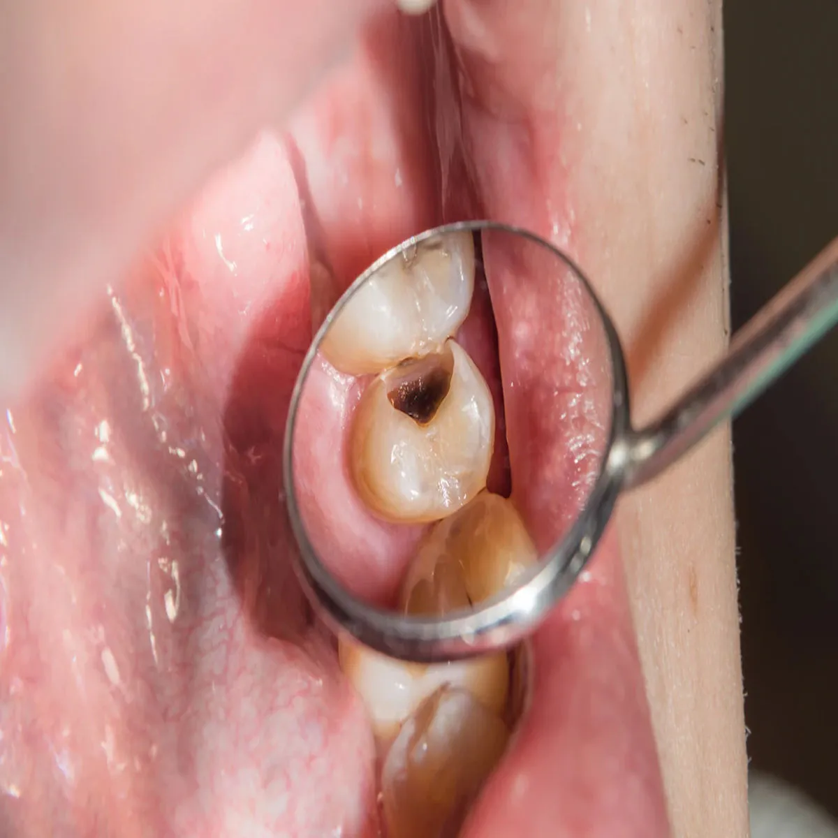 Oralhealth Oralhealth Danton Kaiviti Drd Raht