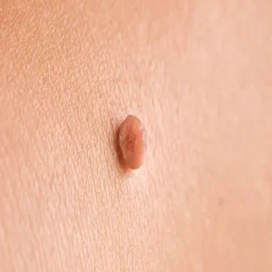 skin tags health warning signs