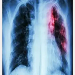 Tuberculosis - – - शाहजहांपुर - मेडिकल - कॉलेज - में - टीबी - मरीज