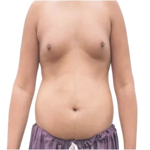 body fat distribution men vs women explained