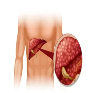 fatty liver doctor tips for recovery