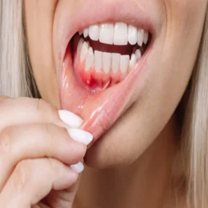mouth ulcers home remedy tips