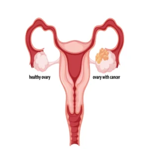 ovarian cancer early warning signs