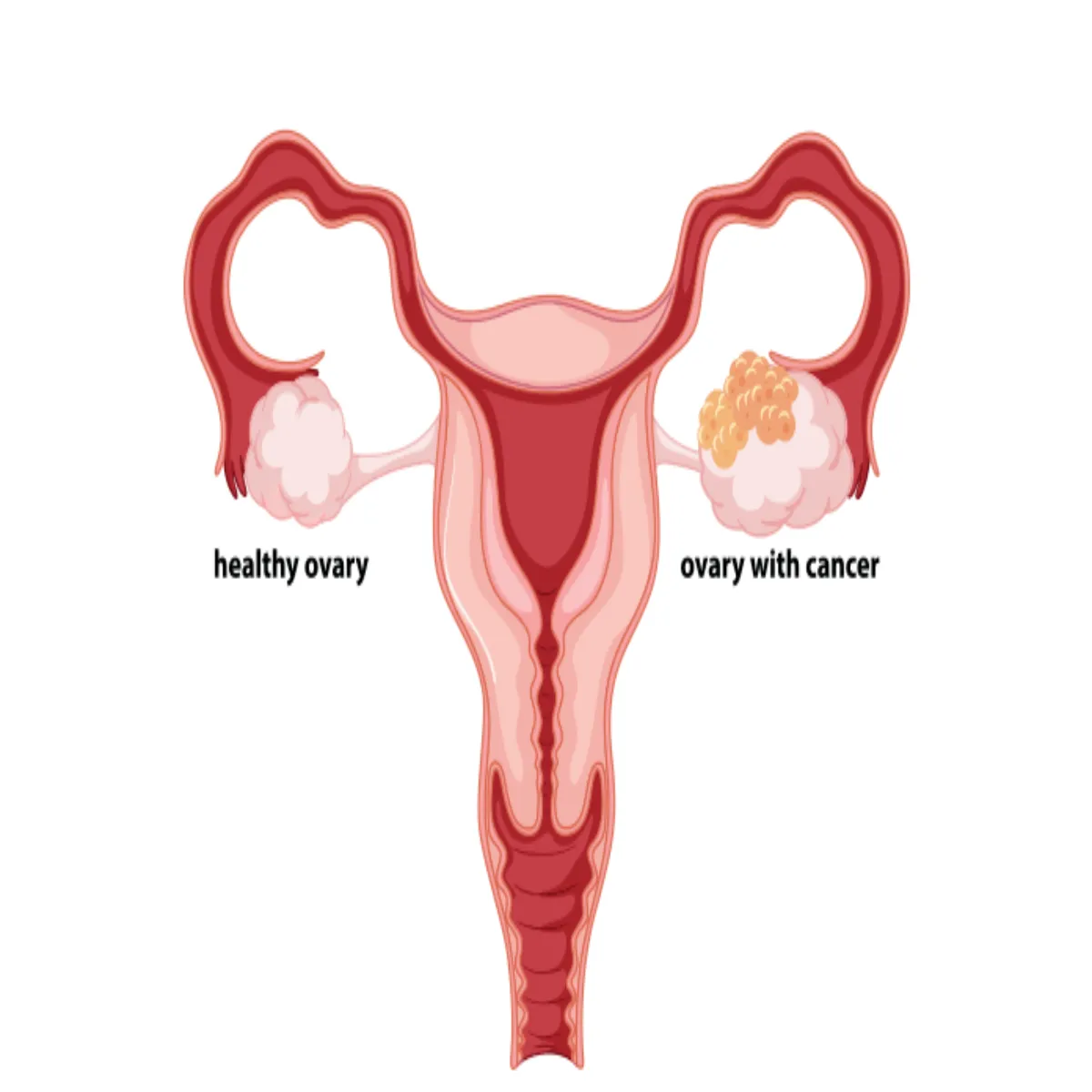 Ovariancancer Ovariancancer Mhilaon Men Bdhta Overiyn