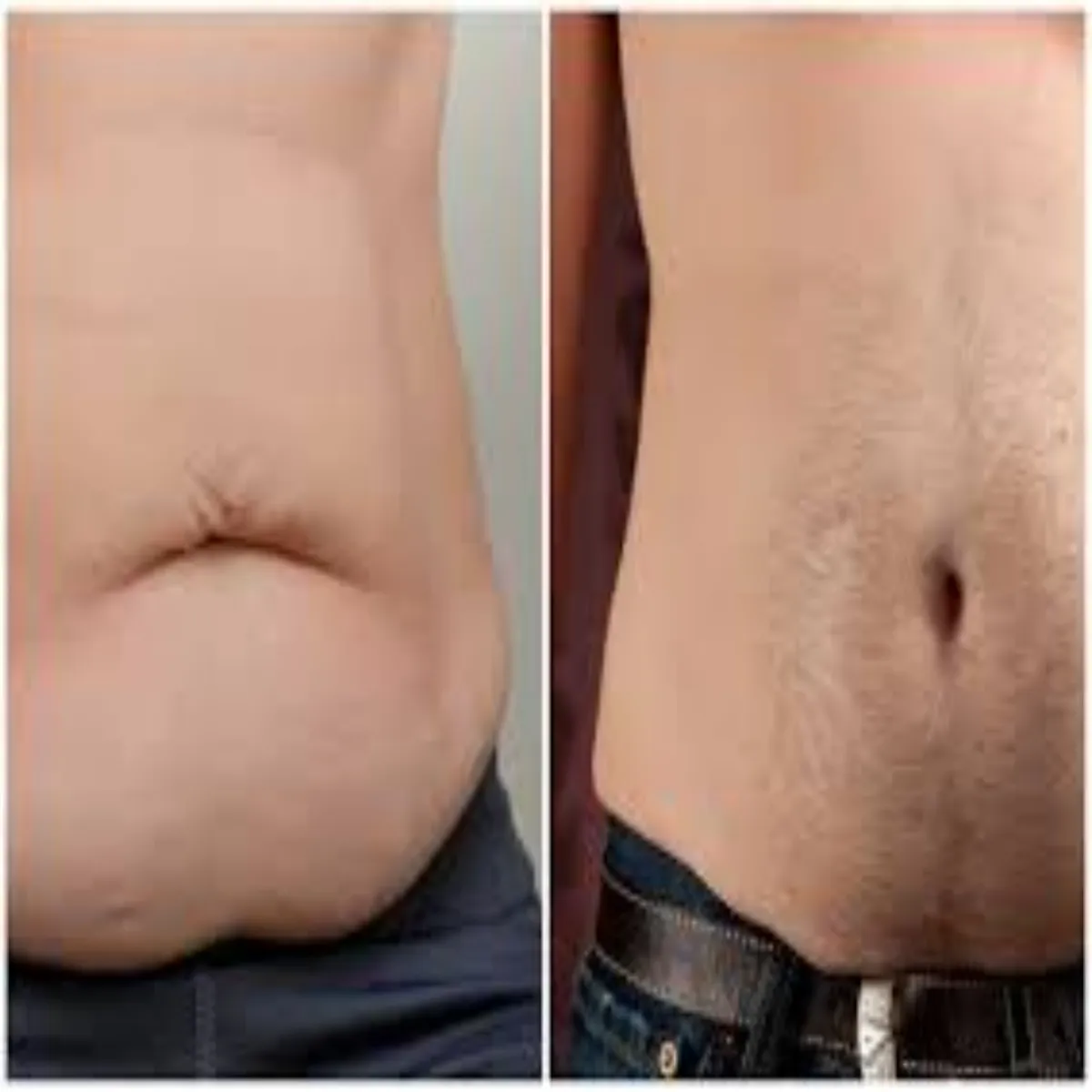 Visceralfat Visceralfat Skht Pet Chrbi Kyon