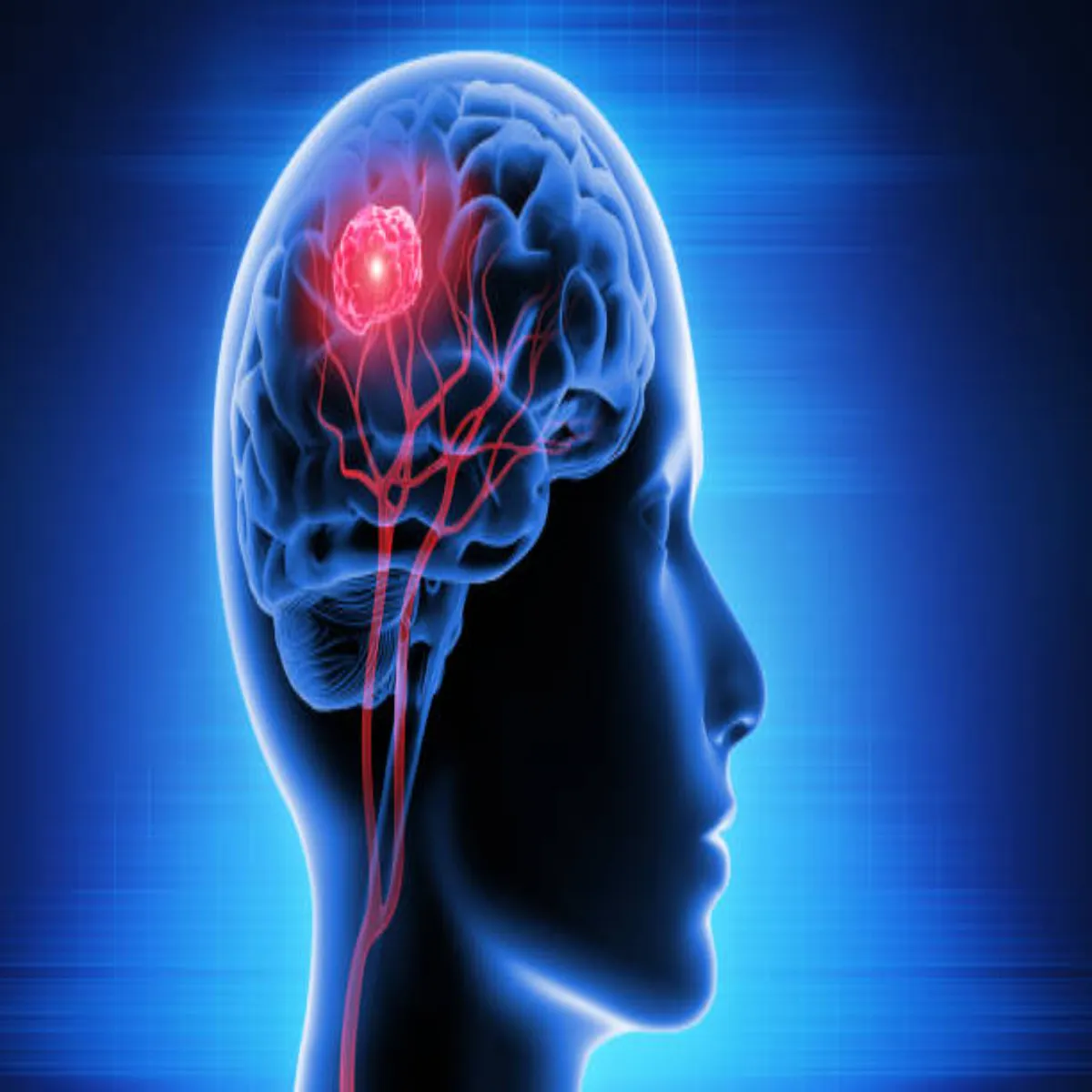 Braintumor Braintumor Lgatar Sirdrd Sath Dikhen