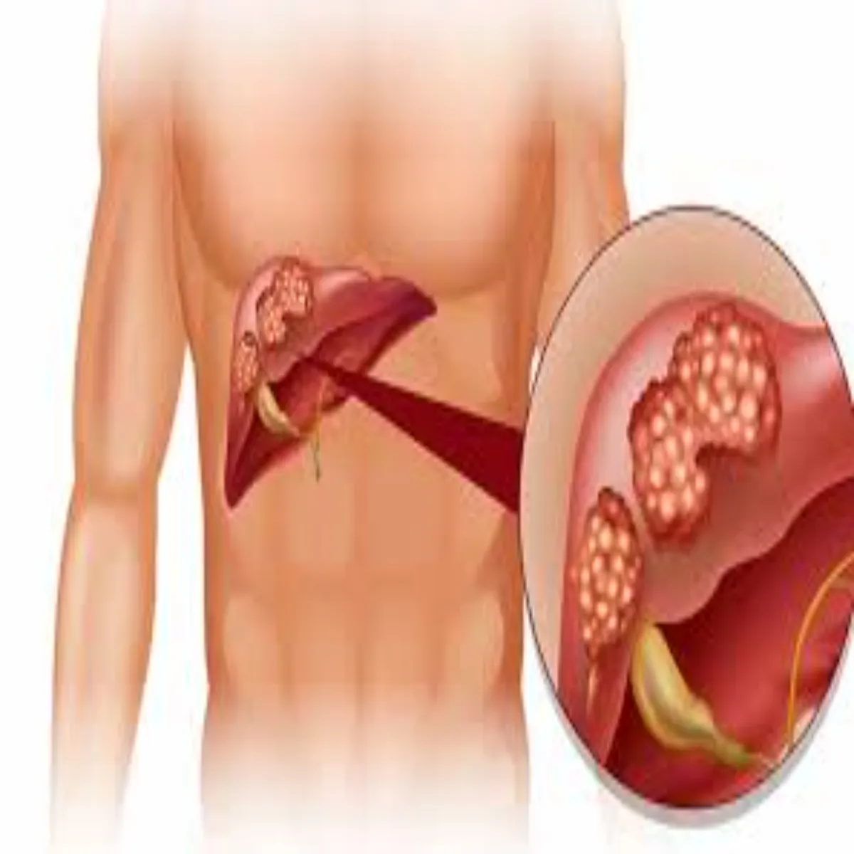 Fattyliver Fattyliver Aam Smjhi Jane Vali