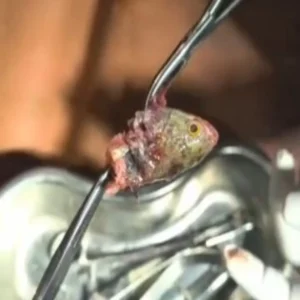 fish head stuck throat surgery