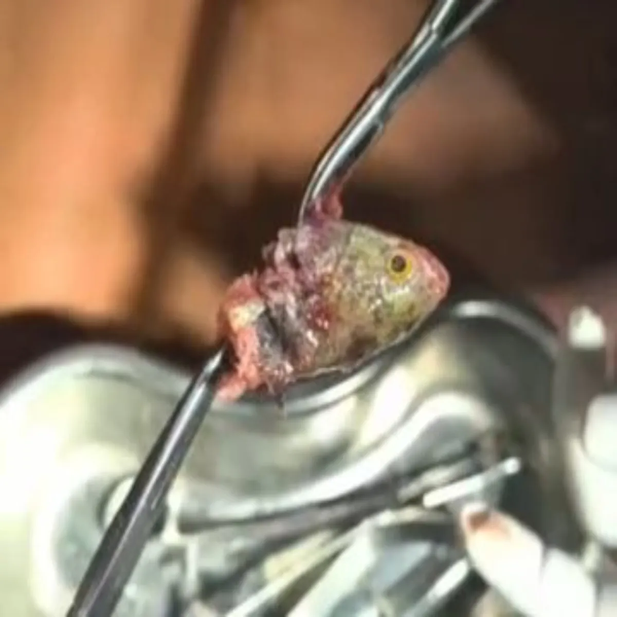 Surgery Surgery Gle Men Phnse Mchhli