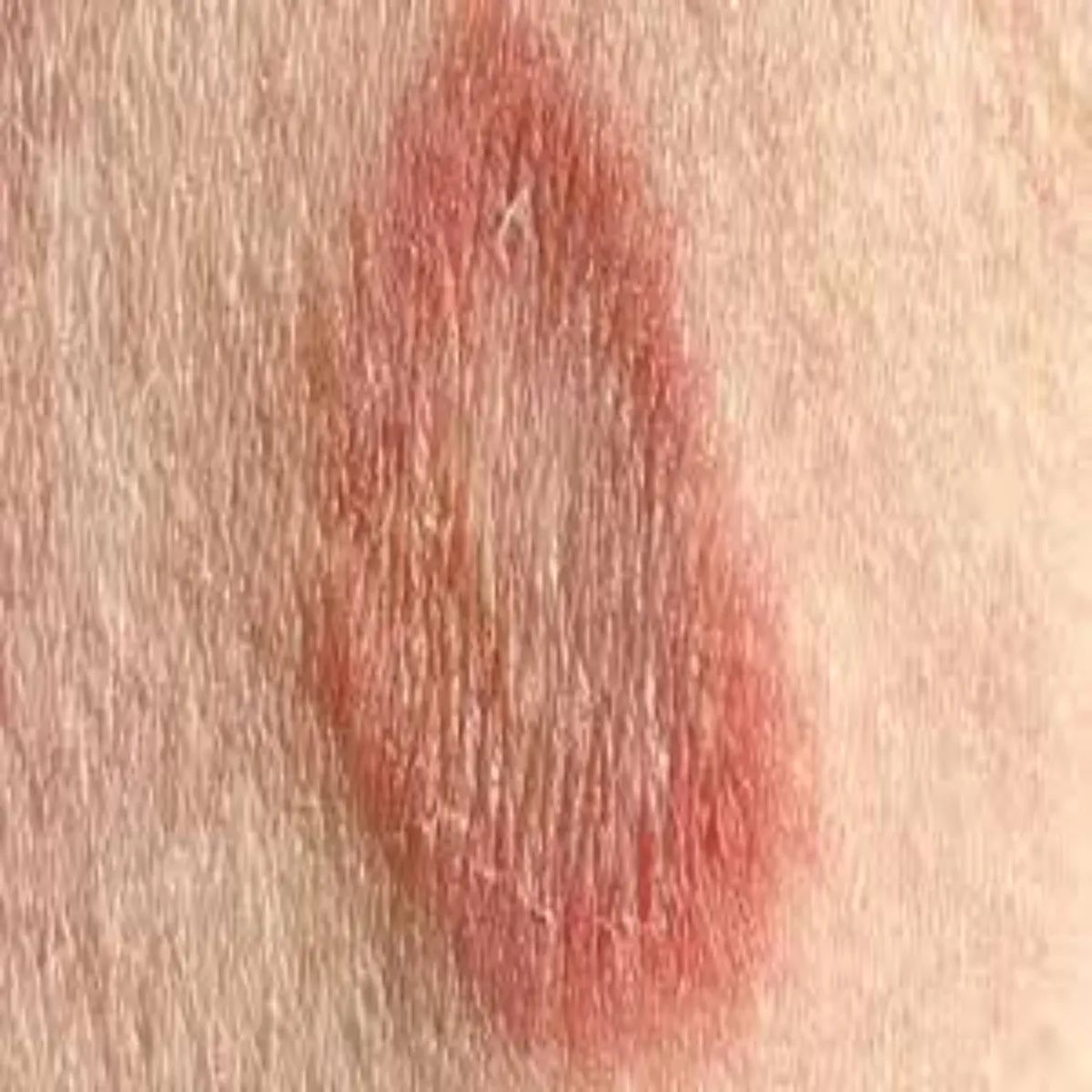Fungal Infection Fungal Infection Pen Grmiyon