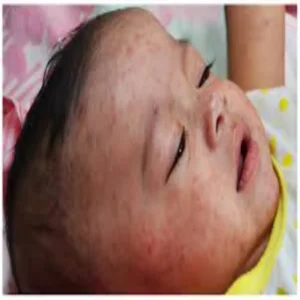 india sends measles aid maldives
