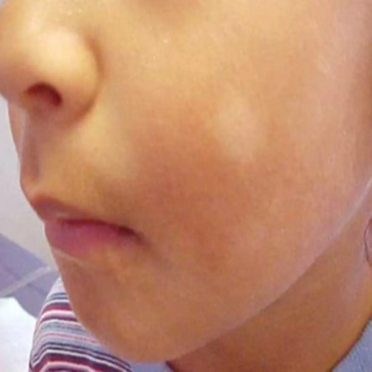 Vitiligo Vitiligo Bchchon Men Bdh Rhe