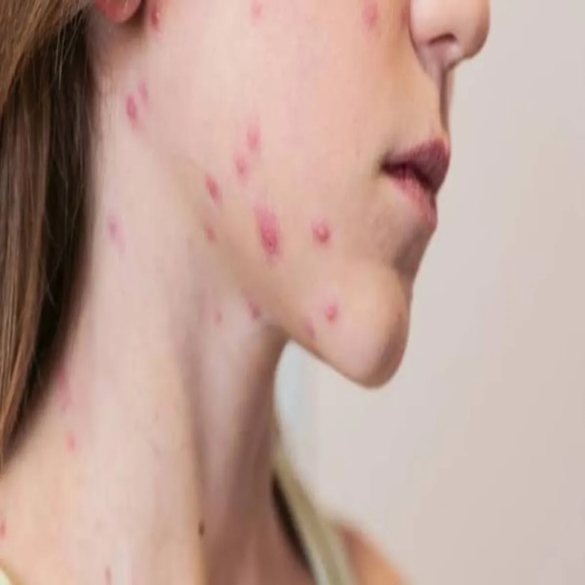 Health Health Chiknpks Shuruaati Snket Phchanen