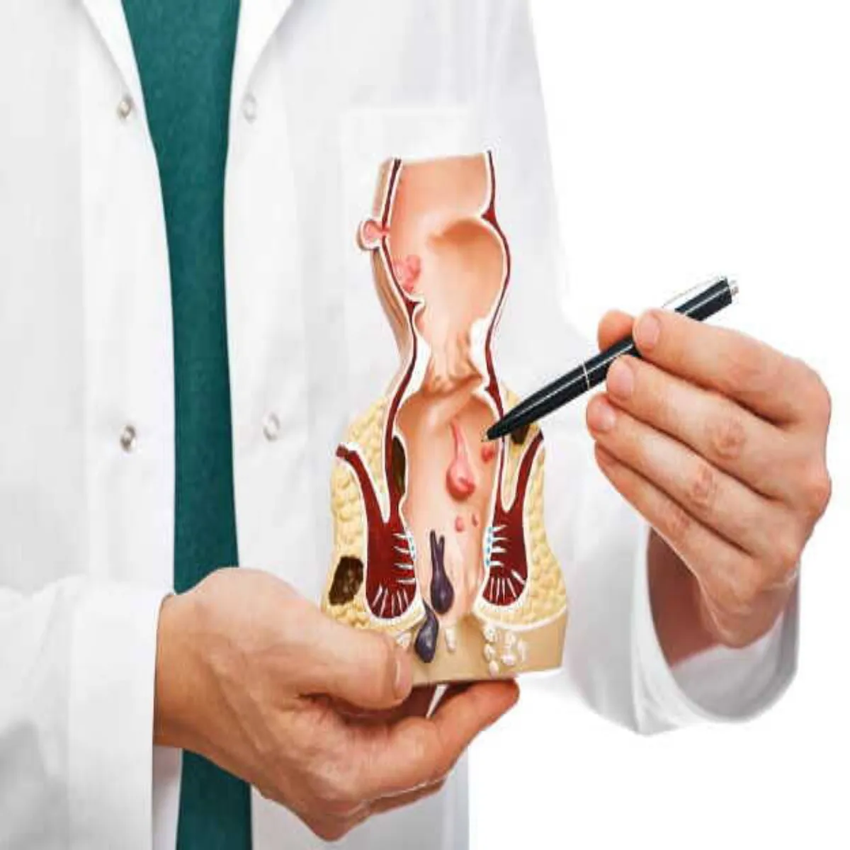 Hemorrhoids Hemorrhoids Shuruaati Pails Men Raht