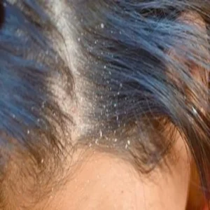 hair care dandruff home pack