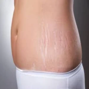 skincare stretch marks care tips