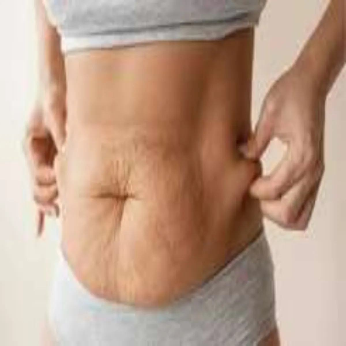 Stretchmarks Stretchmarks Strech Marks Krne Aasan