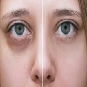 darkcircles potato vs cucumber care