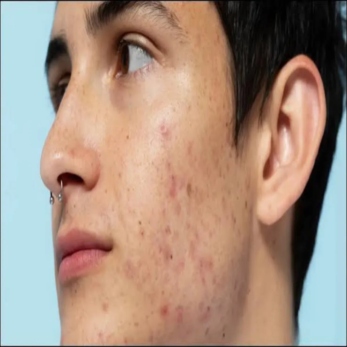 Acne Acne Purushon Men Bar Hone
